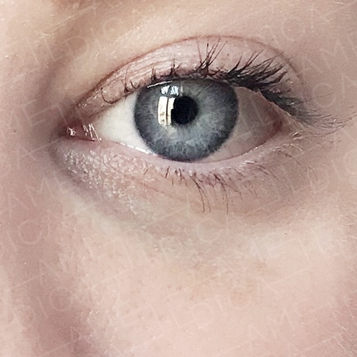 before-treatment-image