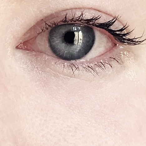 after-treatment-image