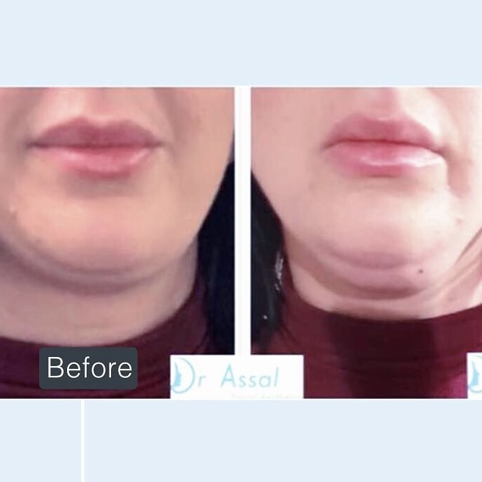 Fat dissolving Double chin (Submental Fat) Celluform Plus Harrow On