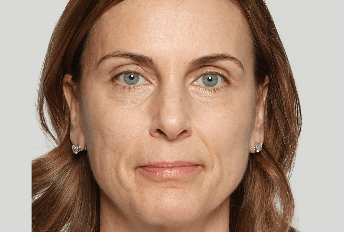 after-treatment-image